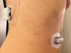 CGM and Insulin pump - I'm a bionic woman!